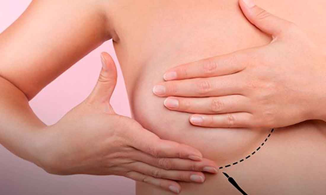 OMS: câncer de mama supera o de pulmão e se torna o mais comum