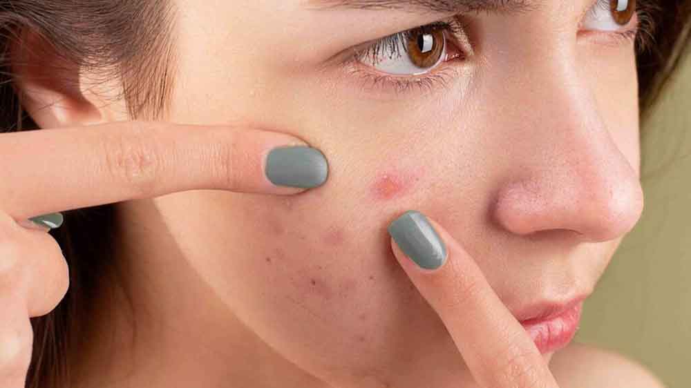 Sociedade médica alerta para uso indevido do remédios para acnes