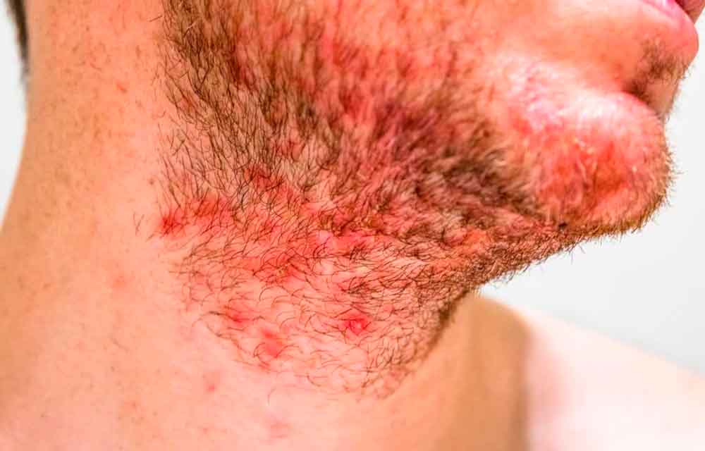 Tem dermatite na barba? Veja dicas de como prevenir e cuidar