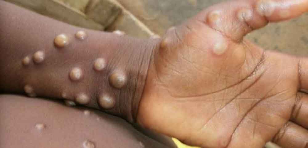 Argentina registra 1º caso suspeito de varíola dos macacos no país