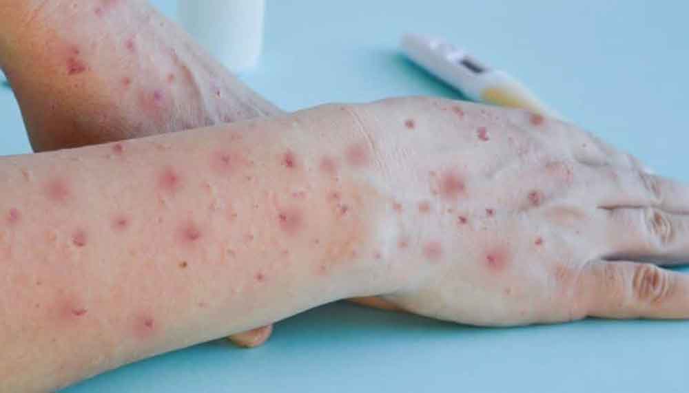 Casos de varíola dos macacos permanecem estáveis, diz ministro