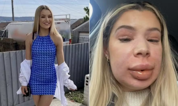 Mulher de 24 anos sofre reação alérgica extrema após aplicação de preenchimento labial