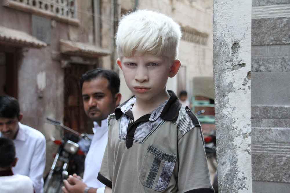 Dia Mundial de Conscientização sobre o Albinismo,13 de junho