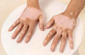 Dia Mundial do Vitiligo promove conscientização e combate o preconceito