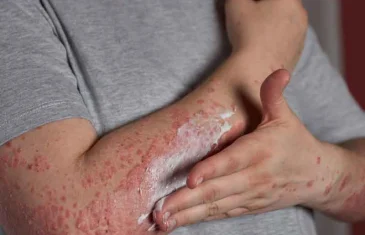 Dia Mundial da Psoríase: chama atenção para a importância do diagnóstico precoce