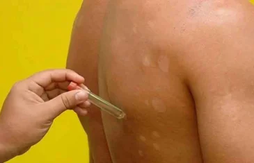 Saúde intensifica ação de combate à transmissão de hanseníase no DF