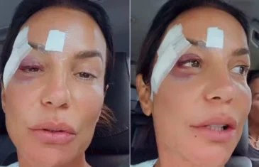 Ivete Sangalo recebe alta e revela diagnóstico médico após queda
